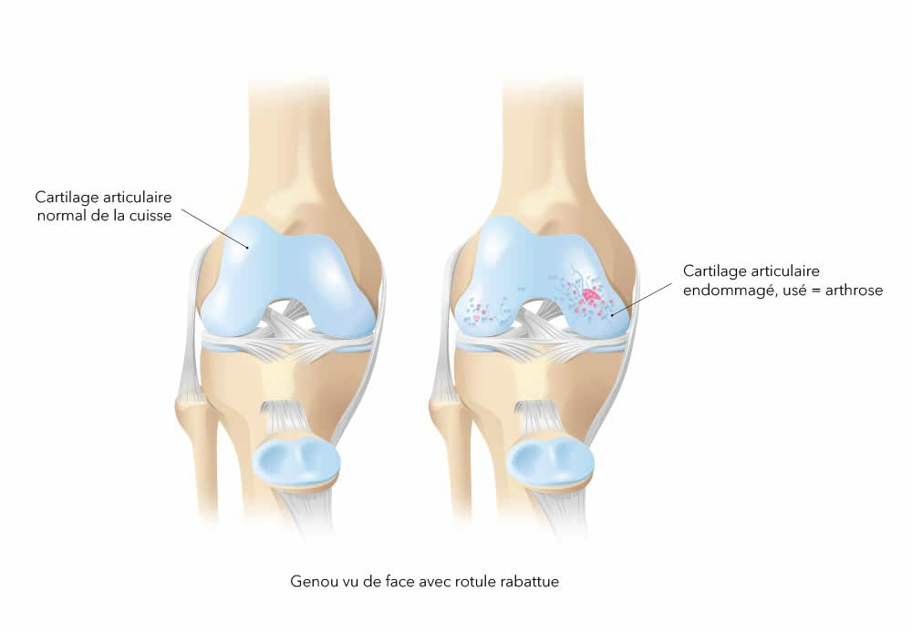 Arthrose du genou : causes et traitements, Dr Polle